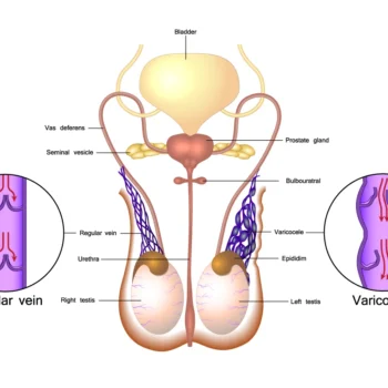 Varicocele Mahbub Homoeo Pharmacy