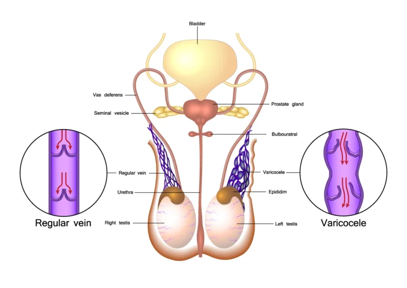 Varicocele Mahbub Homoeo Pharmacy
